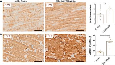 Osteopontin and LDLR Are Upregulated in Hearts of Sudden Cardiac Death Victims With Heart Failure With Preserved Ejection Fraction and Diabetes Mellitus